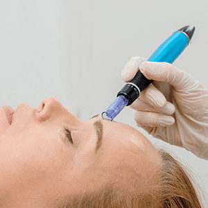 Microneedling with infusion using dermafrac